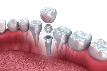 Dental Implant - 3D