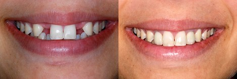 Dental Implants - Before/After